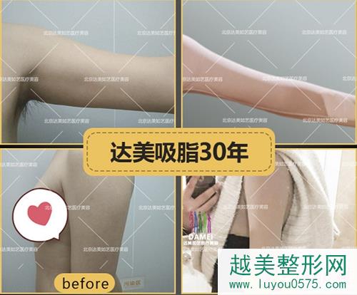 北京达美如艺医疗美容医院手臂吸脂案例