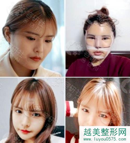 韩国faceline菲斯莱茵轮廓四件套手术案例