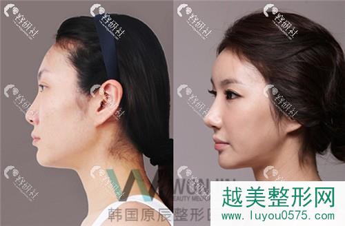 韩国原辰整形医院鼻部手术前后对比照