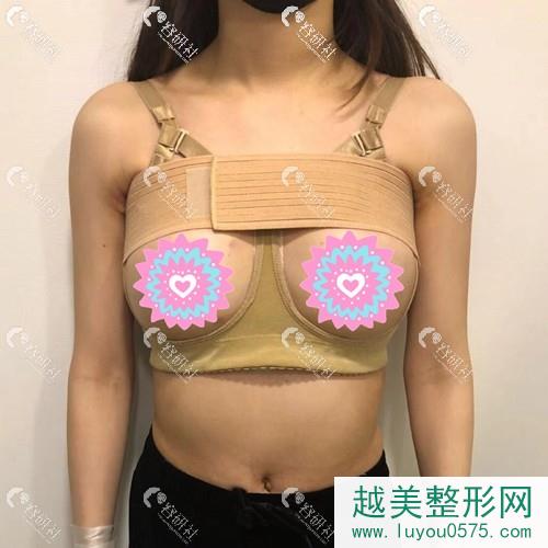 在韩国普罗菲耳做完假体隆胸后穿的塑身衣