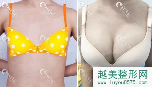北京联合丽格杨大平假体隆胸案例