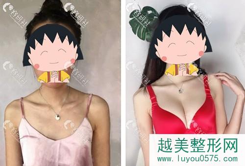北京美莱医疗美容董岩岩假体隆胸案例