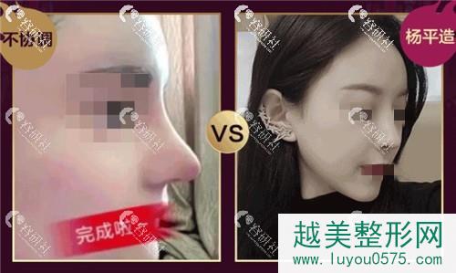 网红鼻与主播鼻的对比