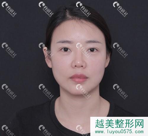 北京沃尔整形刘彦军全肋鼻部手术修复手术前