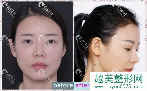 北京沃尔整形刘彦军全肋鼻部手术修复对比案例