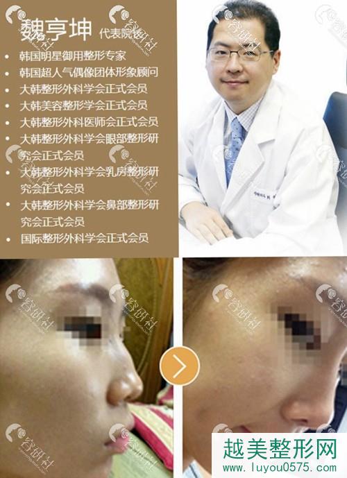 韩国will整形外科医院魏亨坤院长以及鼻整形手术案例