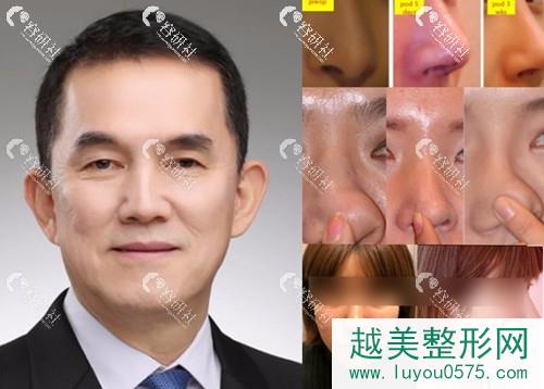 韩国清潭First整形外科李丙玟院长及鼻整形手术案例