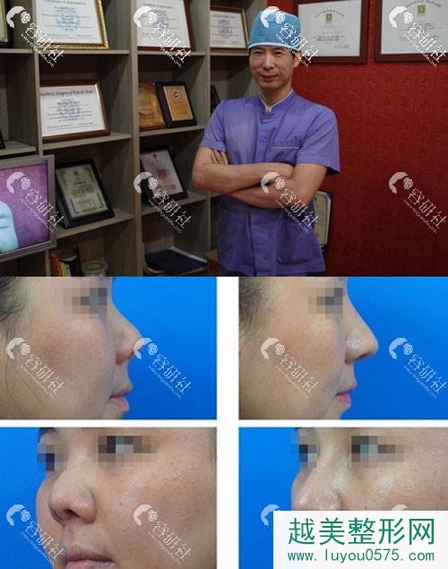 韩国高诺鼻整形外科丁泰荣院长以及鼻整形手术案例