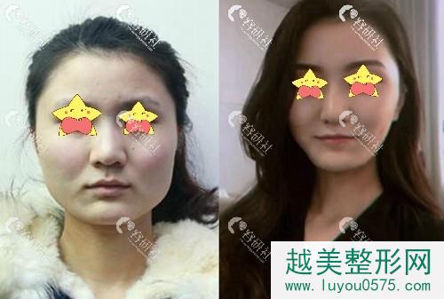 上海时光整形外科医院何晋龙下颌角截骨手术案例