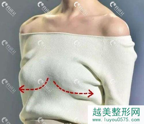 胸部下垂整形案例分享丨看妈妈胸如何回归少女蜜桃胸？