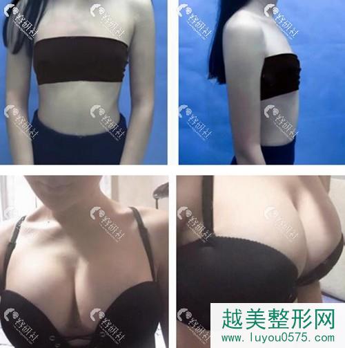 重庆五洲医疗美容范文亮假体隆胸案例