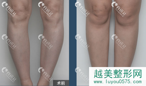 北京艺美医疗美容诊所王东院长O型腿矫正案例