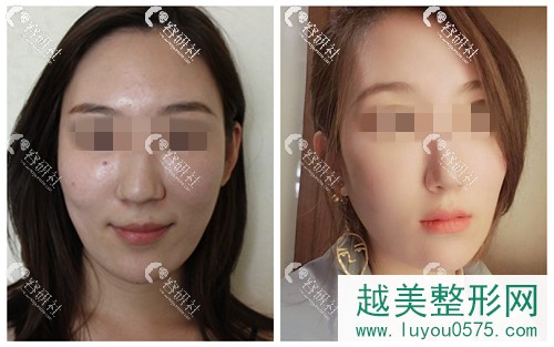 北京宫国华医疗美容诊所手术缩鼻头案例