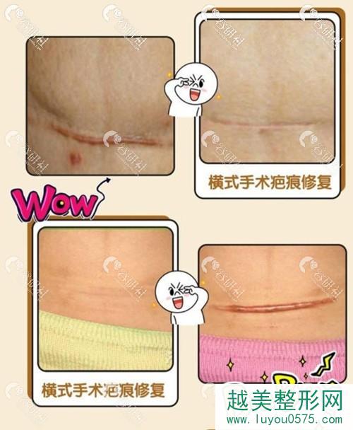 上海茸城医疗美容医院李亚军剖腹产疤痕修复案例