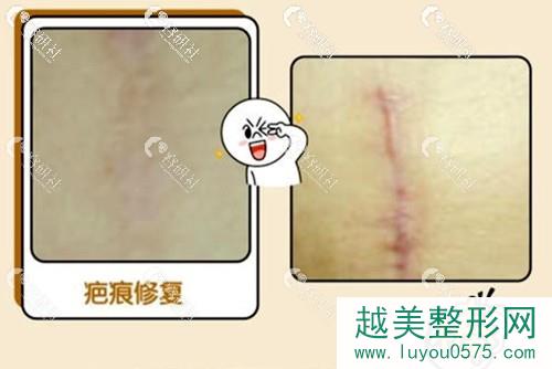 上海茸城李亚军剖腹产疤痕修复前后对比照