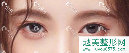 深圳排名前十双眼皮医院医生名单出炉，哪家案例更自然？
