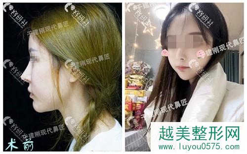 广州颜美荟医疗美容医院于建刚鼻修复术前术后对比