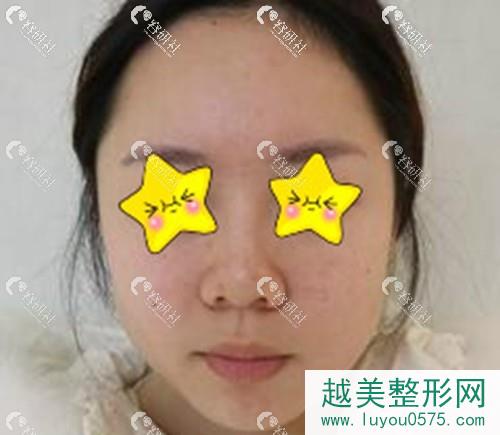武汉鼻整形医生刘波肋软骨隆鼻案例