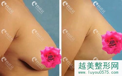 北京大学第三医院整形外科李比教授乳房下垂矫正案例