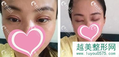 找重庆新铜雀台王杰拉双眼皮术后第三天