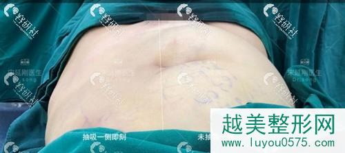 北京美莱医疗美容医院宋延刚腰腹吸脂两边果对比