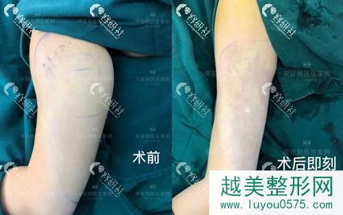 北京美莱医疗美容医院宋延刚手臂吸脂案例