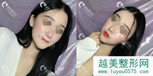 北京禾美嘉医疗美容医院李光洙面部脂肪填充术后一个月