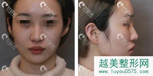 看我找北京米扬丽格巫文云做的隆鼻手术果，大家说毁了吗？
