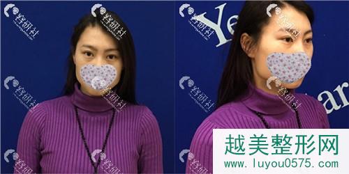 杭州艺星医疗美容医院打注射瘦脸术前