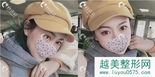 杭州艺星医疗美容医院打注射瘦脸术后15天