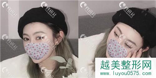 杭州艺星医疗美容医院打注射瘦脸术后25天