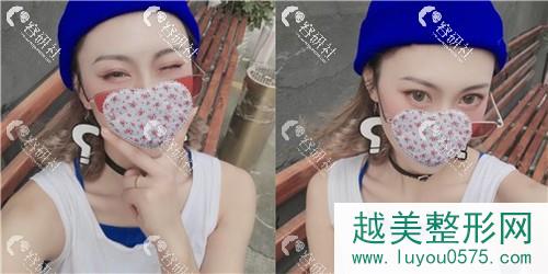 杭州艺星医疗美容医院打注射瘦脸术后100天