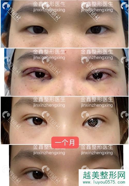 西京医院金鑫双眼皮修复术前术后对比照