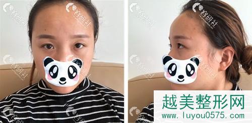 上海光博士医疗美容门诊部做自体脂肪丰泪沟前