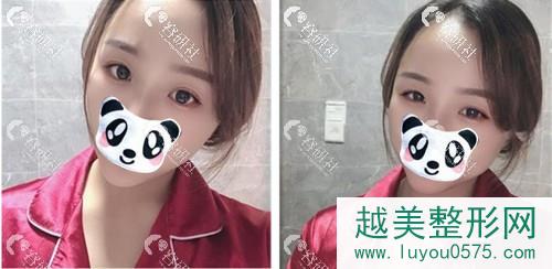 上海光博士医疗美容门诊部做自体脂肪丰泪沟术后7天