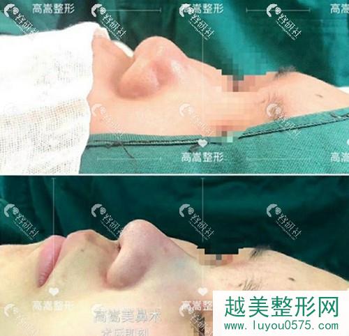 蚌埠医学院第（一）附属医院整形美容外科高嵩隆鼻术前术后对比