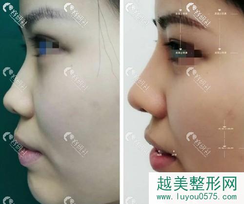 蚌埠医学院第（一）附属医院整形美容外科高嵩隆鼻案例