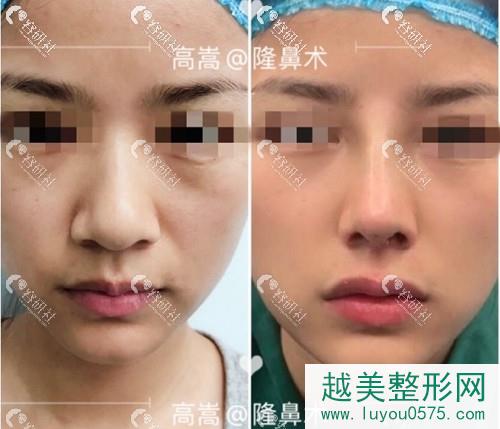 蚌埠医学院第（一）附属医院整形美容外科高嵩隆鼻术前术后对比