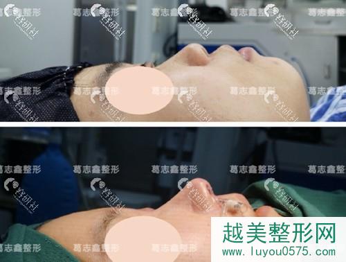 上海知颜医疗美容门诊部葛志鑫隆鼻术前术后对比