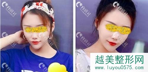 北京京韩医疗美容诊所乔爱军自体脂肪填充全脸术后7个月