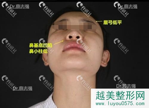 北京俊泰丽格薛志强隆鼻术前存在问题