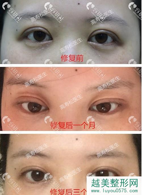 杭州星颜医疗美容诊所高寿松双眼皮失败修复案例
