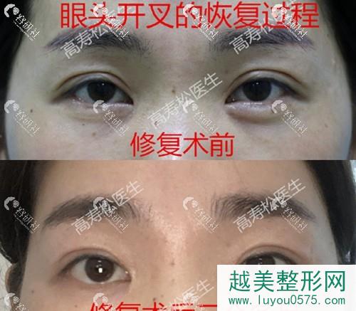 杭州星颜医疗美容诊所高寿松双眼皮失败修复恢复前后对比照