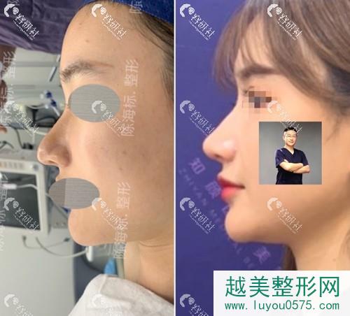 上海知颜陈海标隆鼻术前术后对比照