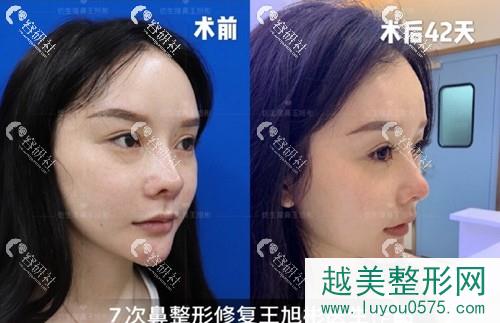 广州睿斯医疗美容医院鼻修复术前术后对比