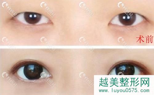 杭州艺星医疗美容医院杨连华眼部手术术前术后对比照