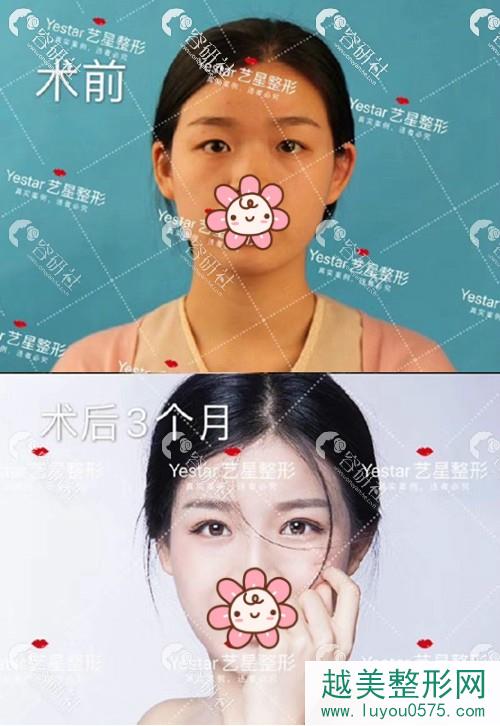 杭州艺星医疗美容医院杨连华美杜莎眼部手术术前术后对比