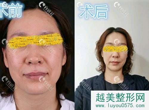 杭州时光医疗美容医院刘耿激光美肤激光前后对比图