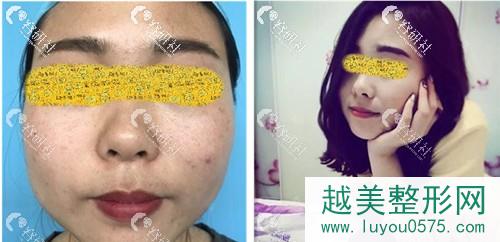 武汉同济医院整形美容科吴敏注射瘦脸前后对比照
