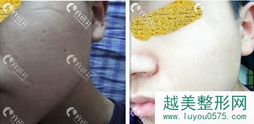 武汉同济医院整形美容科罗晓激光祛痘印疤痕案例